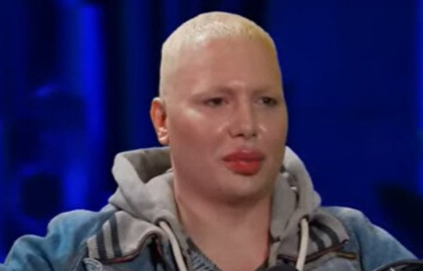 NI ROĐENA MAJKA GA NE BI PREPOZNALA! Evo kako je Brendon izgledao pre svih operacija, procurile šokantne fotke!