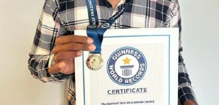 LJUDI SU BEŽALI OD NJEGA, A DANAS JE SVETSKA ZVEZDA Šokantna priča najdlakavijeg dečaka na svetu, evo kako danas izgleda (FOTO)