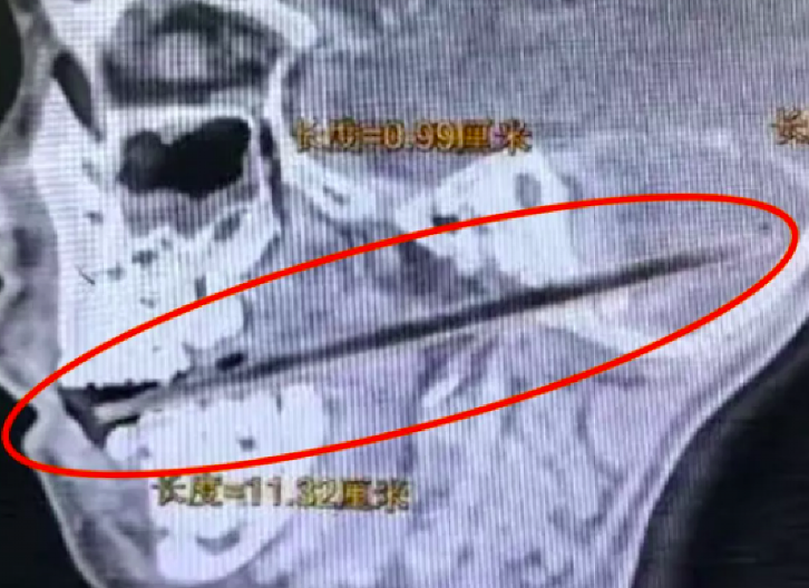 LIZALICA IZVUČENA IZ MOZGA DETETA Za dlaku izbegnuta tragedija (FOTO)