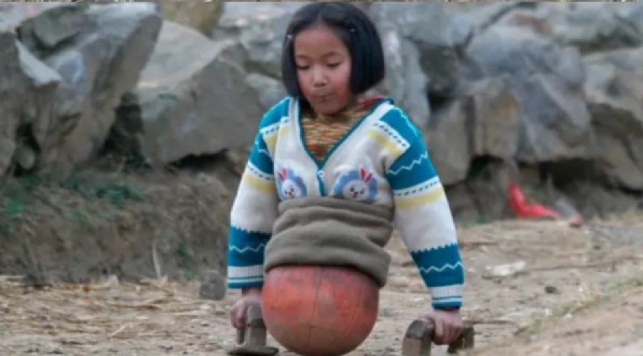 DEVOJČICA SA LOPTOM UMESTO NOGU DANAS IMA 29 GODINA Svet je nekad plakao zbog nje, a evo gde je sada! (VIDEO)