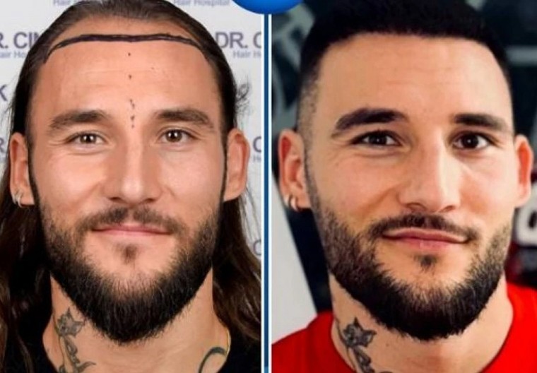 NIJE SAMO CECIN ZET PRESADIO KOSU I ovi poznati muškarci nisu žalili para za ulepšavanje