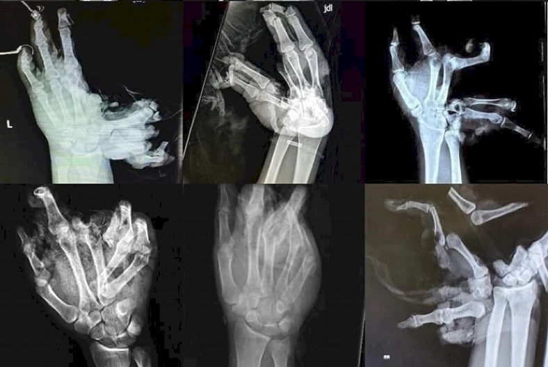 OVAKO IZGLEDA KADA VAM PUKNE PETARDA U RUCI "Šaka je obično u najlonu, iz nje curi krv, padaju komadi koste i kože!