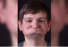 OD PACIJENTA BEZ ZUBA SA "ZGUŽVANIM LICEM" NAPRAVIO MANEKENA: Stomatolog izveo magiju, ovakvu transformaciju još niste videli (FOTO)