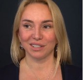 SA 52 GODINE LANA JE ŽELELA DA PONOVO IZGLEDA KAO SA 18 Hirurgu je donela jednu jedinu fotografiju, pogledajte njen novi izgled (UZNEMIRAVAJUĆI VIDEO)