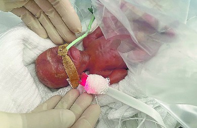 PODVIG NEMAČKIH LEKARA: Spasli bebu tešku samo 300 grama!